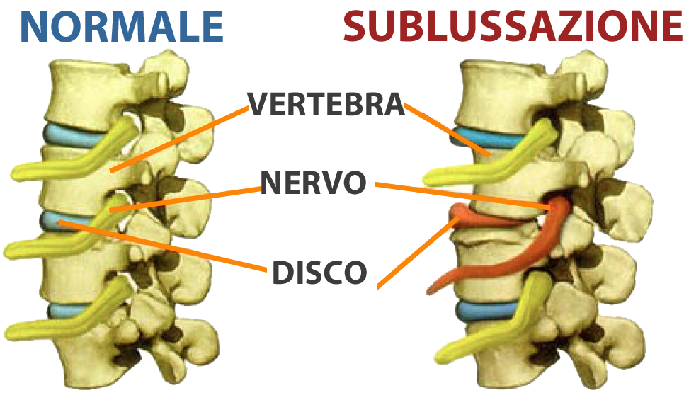 Sublussazione vertebrale
